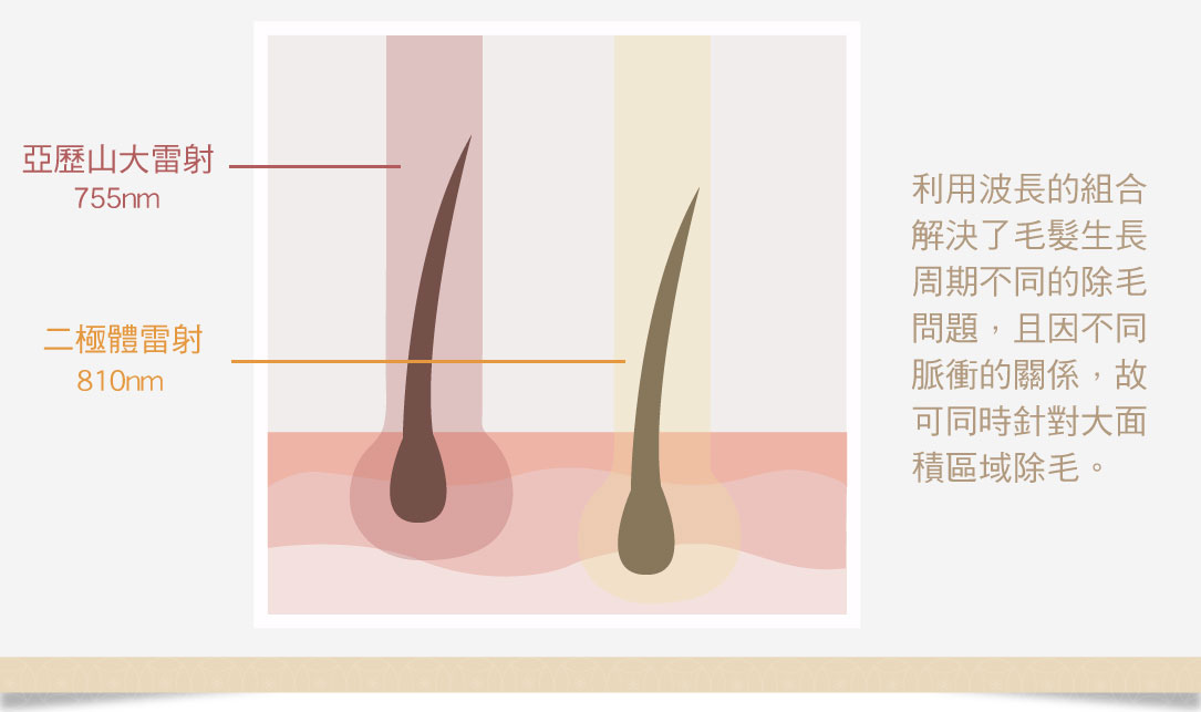 海神除毛雷射