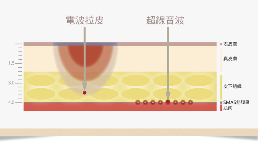 鳳凰電波拉提治療原理