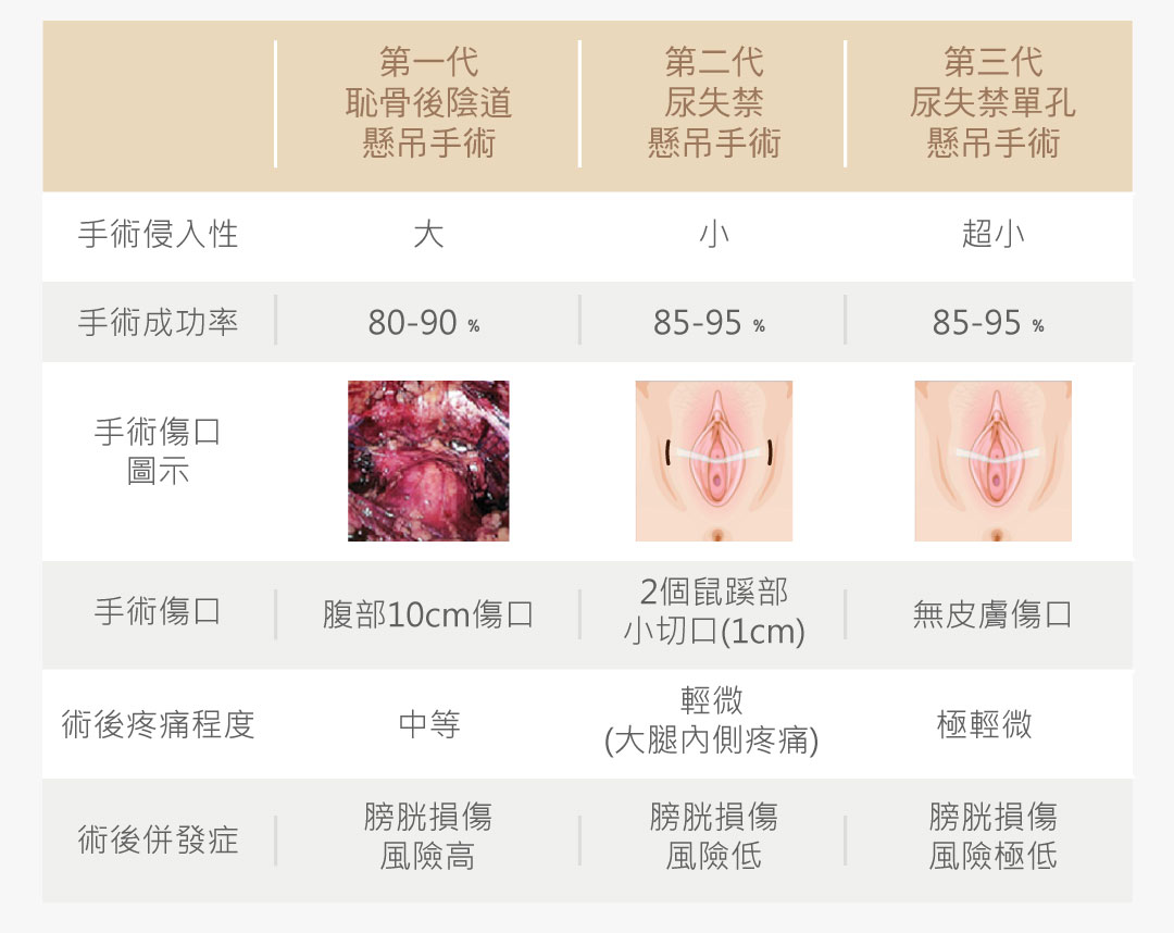 尿失禁懸吊手術