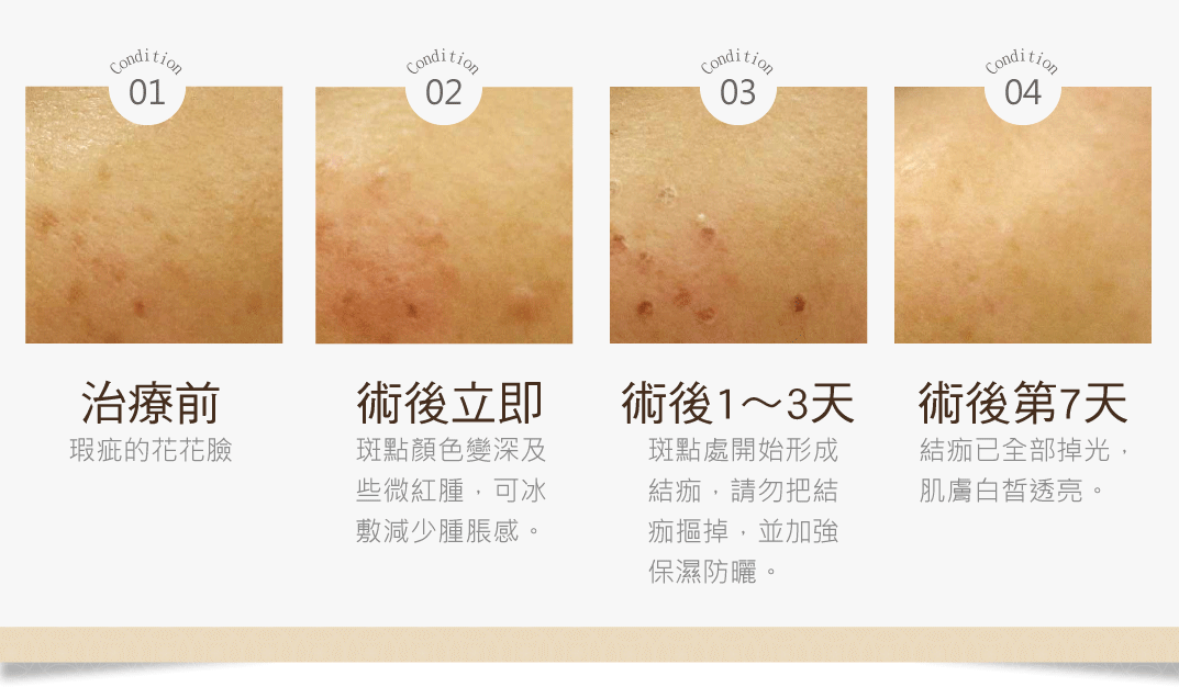 柔皮秒案例