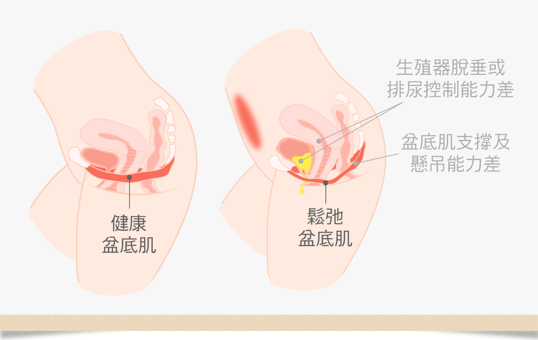 盆底肌鬆弛