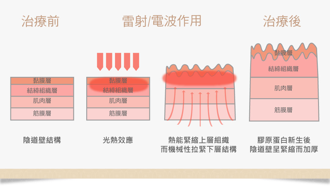 私密處乾澀治療方式：陰道雷射作用原理）