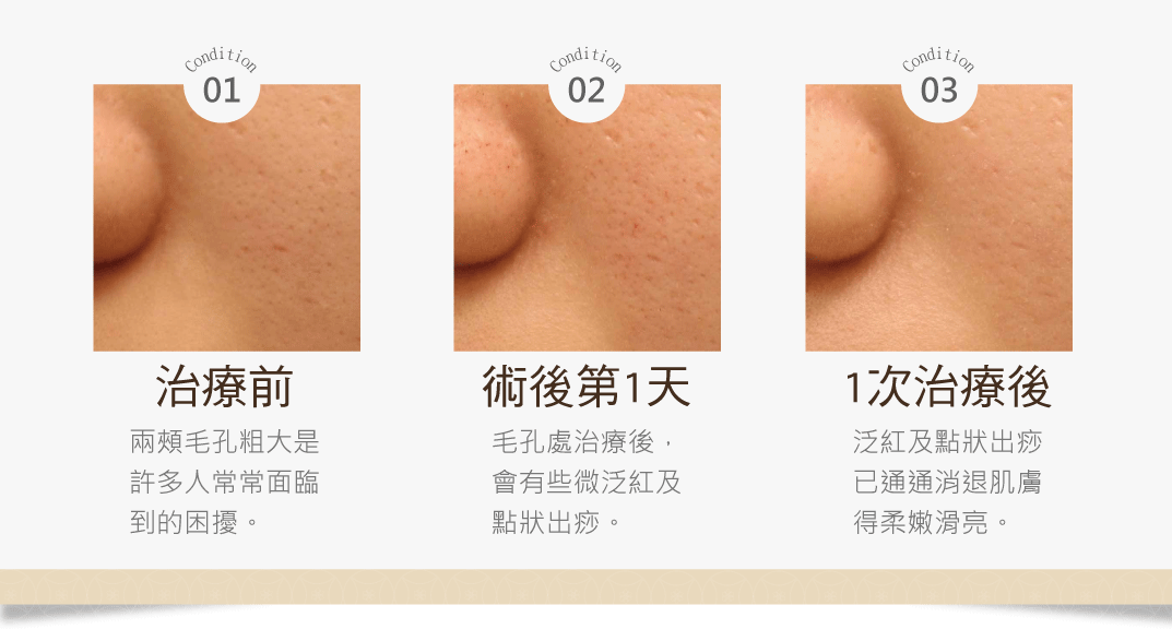 柔皮秒案例