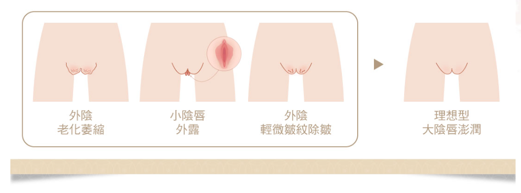 大陰唇澎潤適合族群