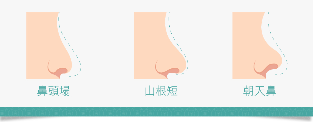 鼻雕線療程
