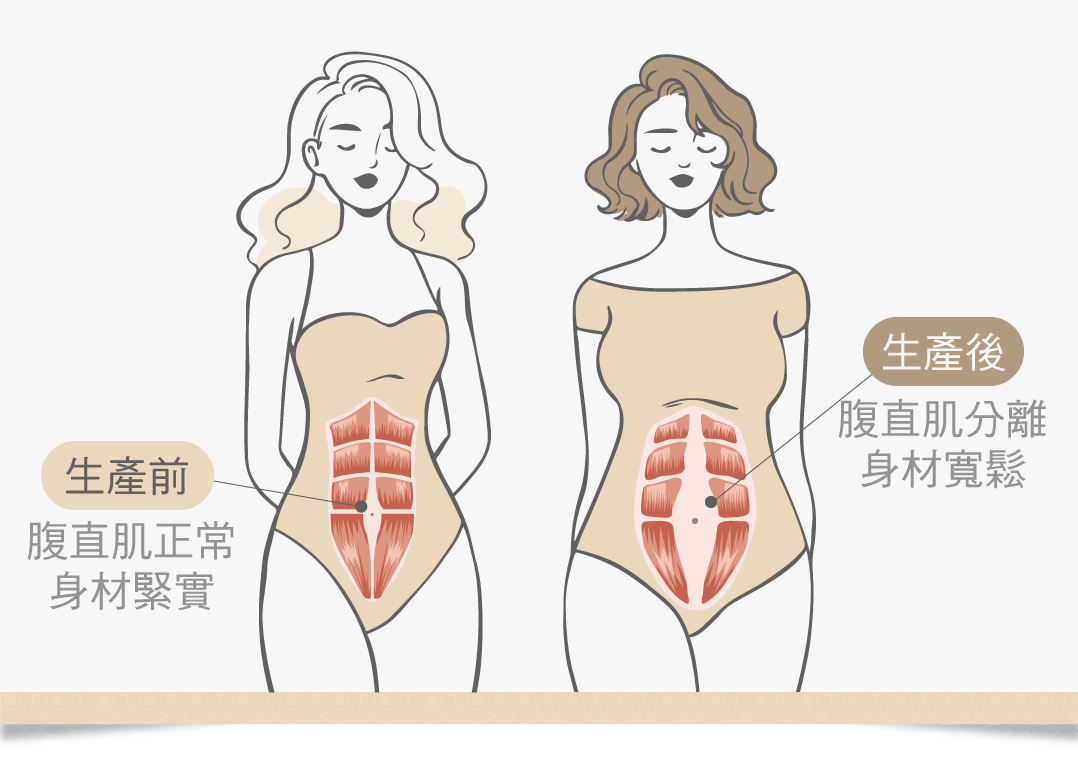 腹直肌分離