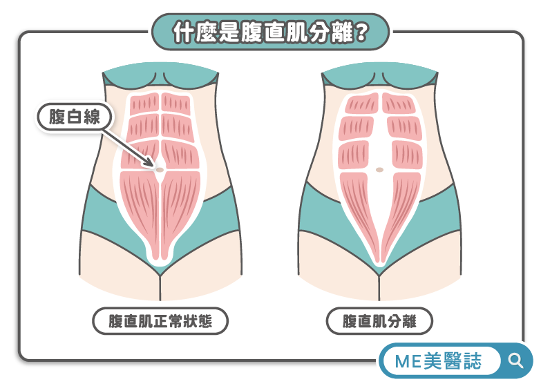 什麼是腹直肌分離?