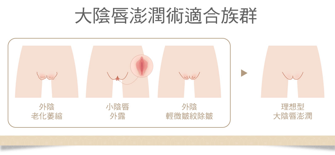 大陰唇澎潤適合族群