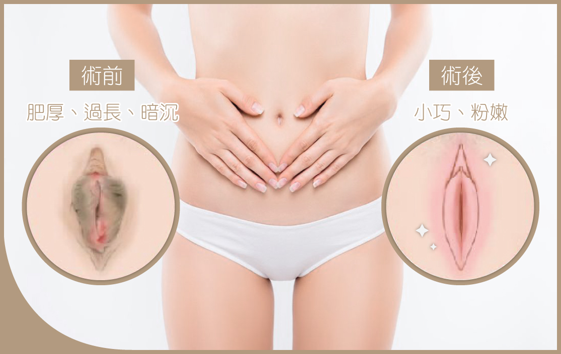 小陰唇術前術後 