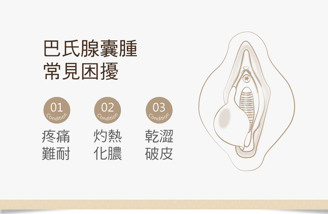 巴氏腺囊腫