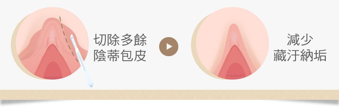 陰蒂包皮修整示意