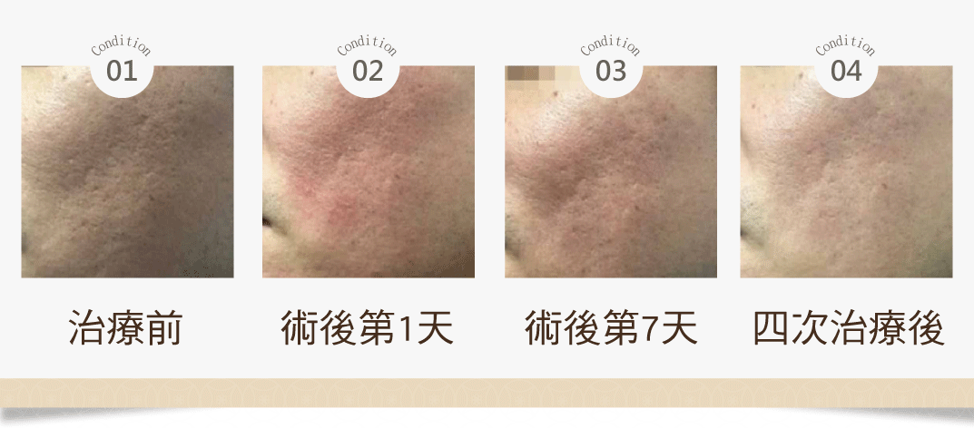 柔皮秒案例