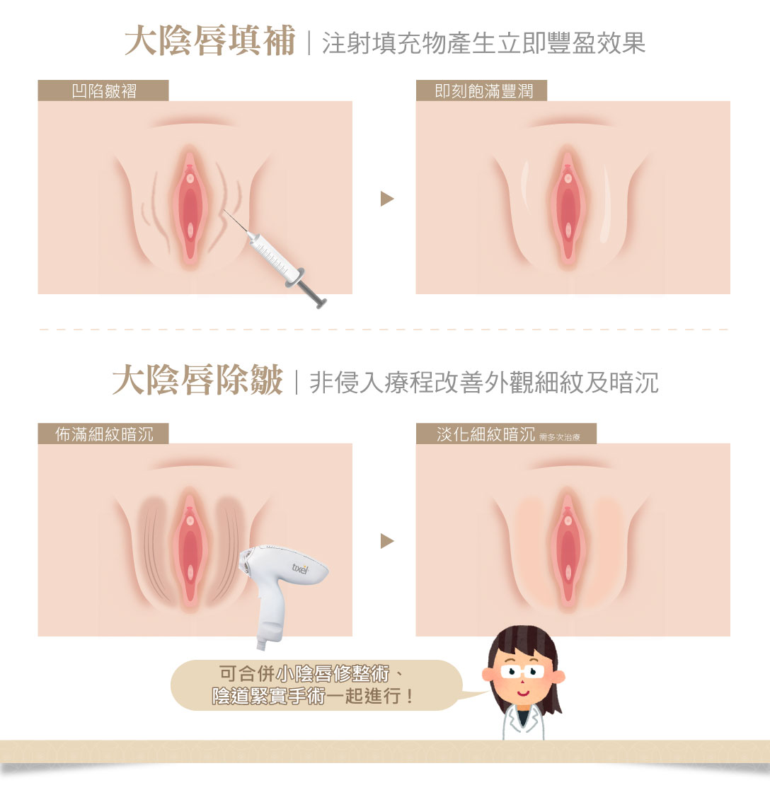 大陰唇填補豐潤