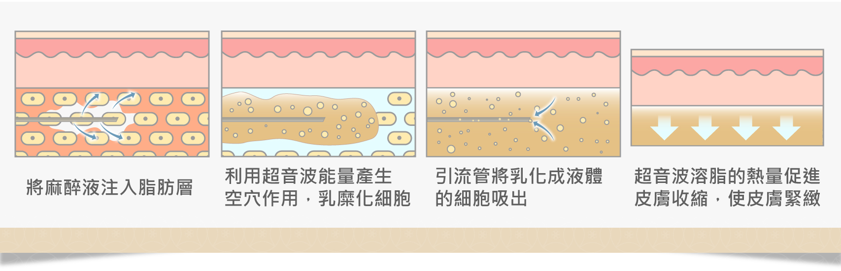 超微管超音波抽脂特色