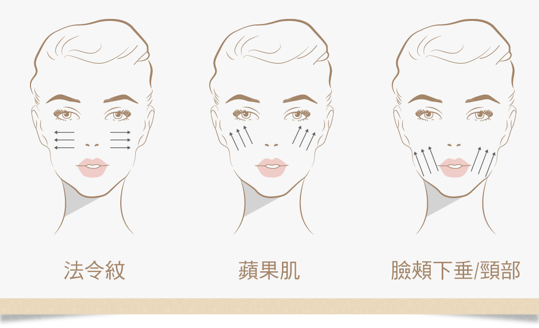 埋線拉提